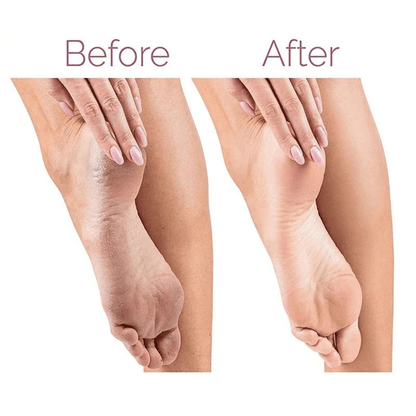 Callus Remover™ - Moeiteloze pedicure perfectie voor zachte voeten!